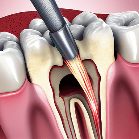 root canal treatment