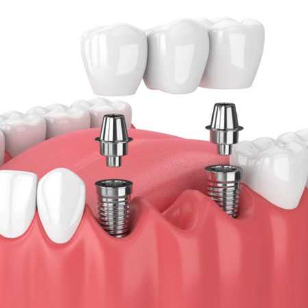 veneers